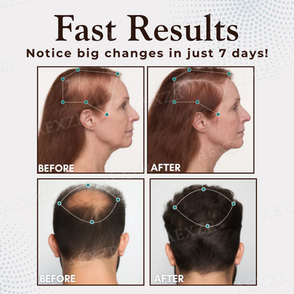 Best Seller 🎉limited-time discount| Healrize® Hair Regrowth Capsules 💖Revive Follicles, Boost Hair Volume